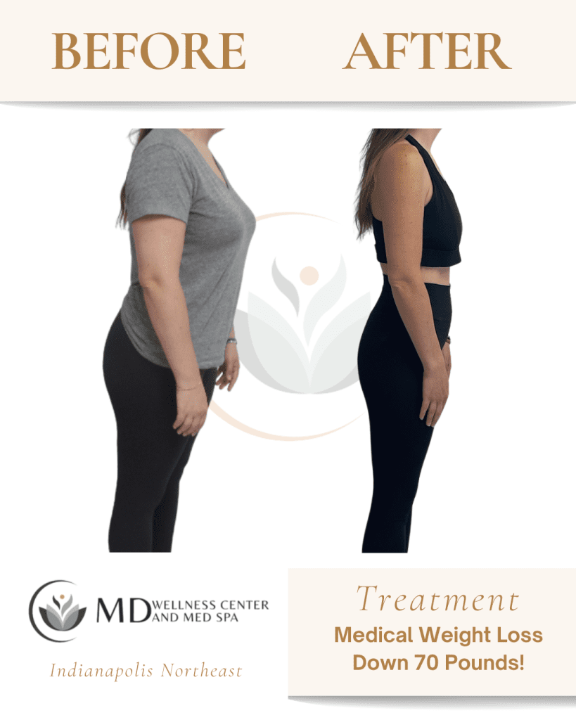 https caloriebee.com misc b12-lipotropic-injections-weight-loss Medical Weight Loss | Lipotropic B12 Shots Glossitis and hyperpigmentation of Heart Options:Immunity Defense (Single Treatment)