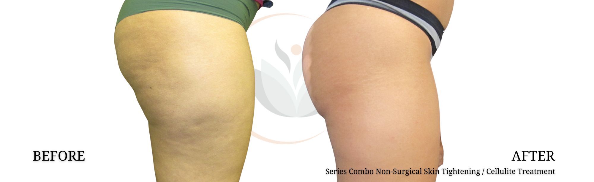 l carnitine cellulite reduction Cellulite Reduction Injections