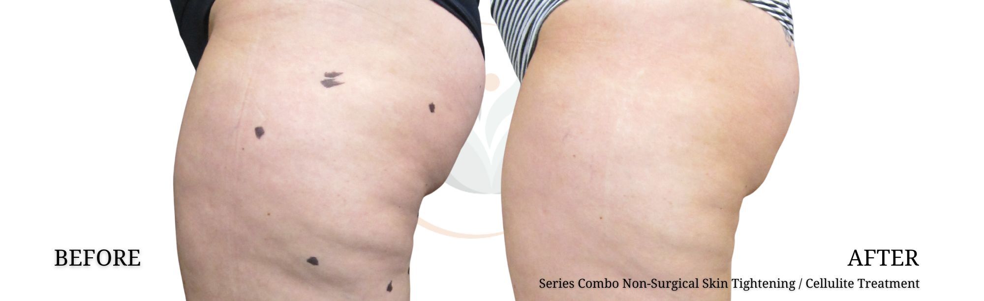 l carnitine cellulite reduction Cellulite Reduction Injections