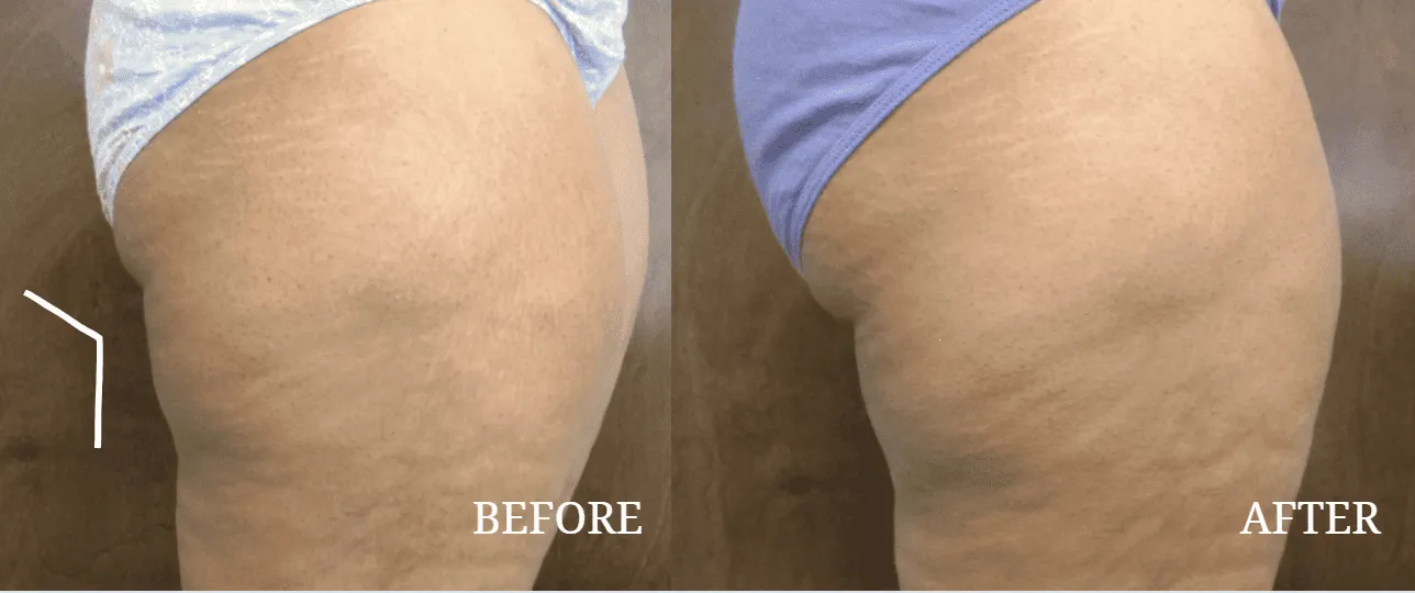 does l carnitine help with cellulite Cellulite Reduction Injections