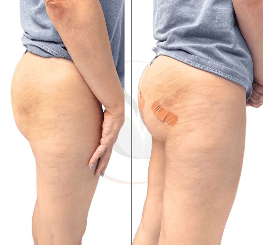 non-surgical buttocks firming treatments after glp-1 Non-Surgical Butt Lift in Indianapolis | Carmel