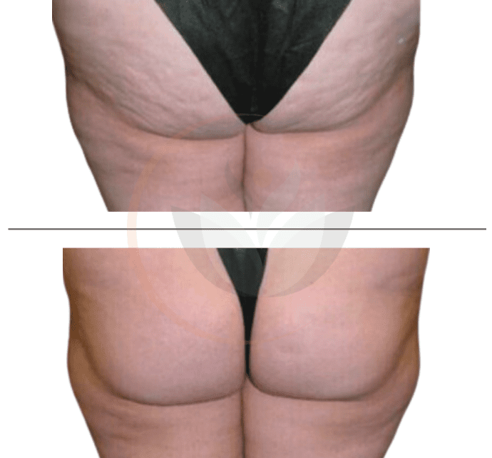 non-invasive thigh laxity treatment post-glp-1 therapy Non-Surgical Fat Reduction for Sagging Thighs in Indianapolis