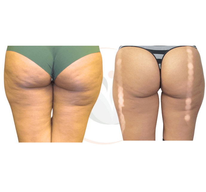 b12 injections for cellulite Treatment In Indianapolis Vitamin Supplement Reduced calorie diet combined Size:30mL