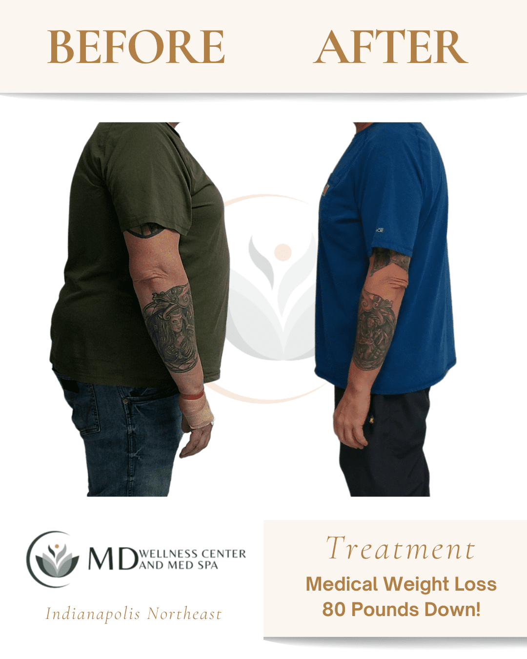 b12 injections indianapolis Medical Weight Loss | Lipotropic B12 Shots