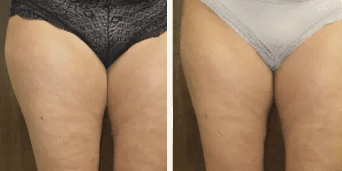 cjc-1295 / ipamorelin growth hormone secretagogue LAPULITA Anti Cellulite Spray main image 1