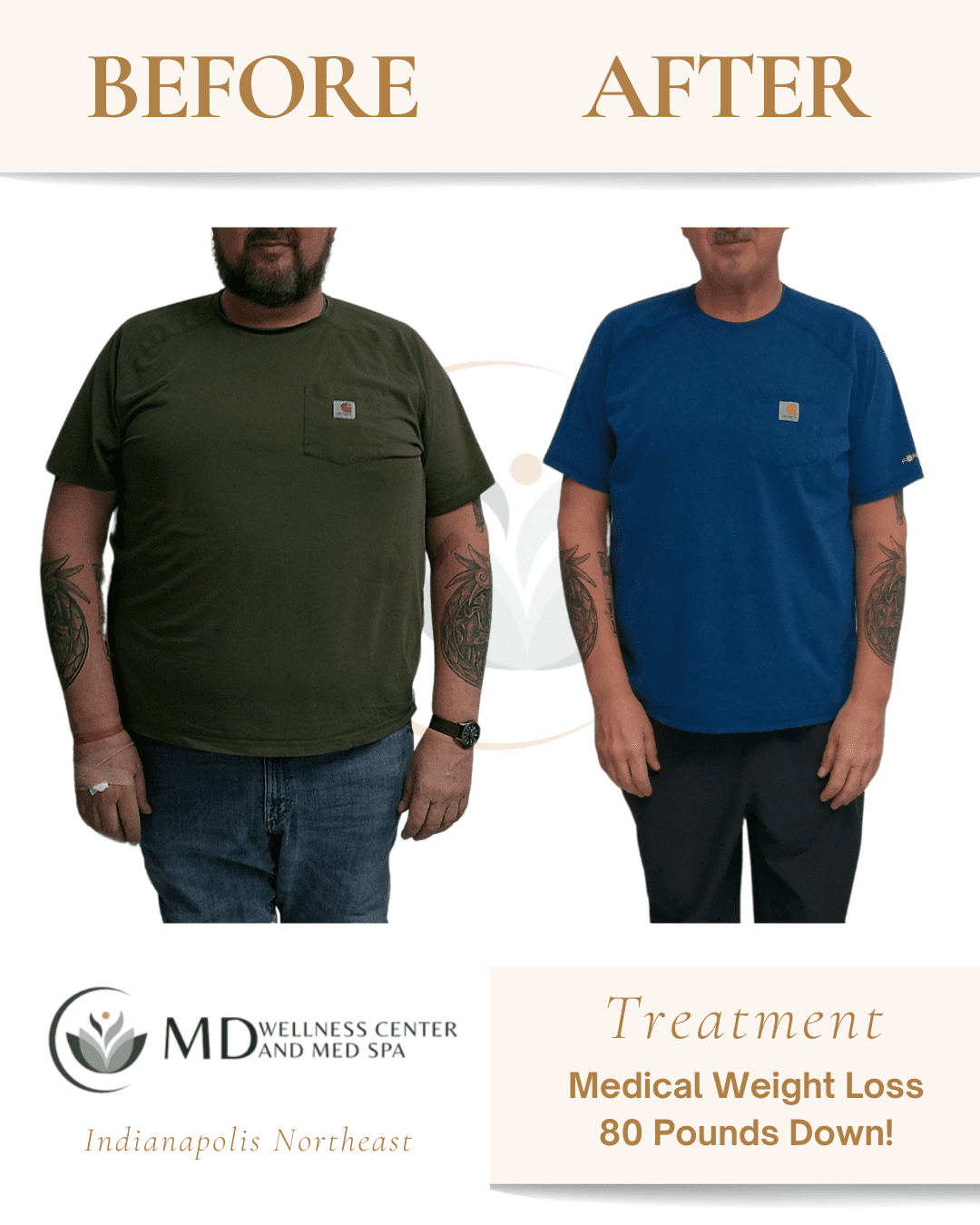 glp-1 indianapolis in GLP-1 Weight Loss Injections in Indianapolis