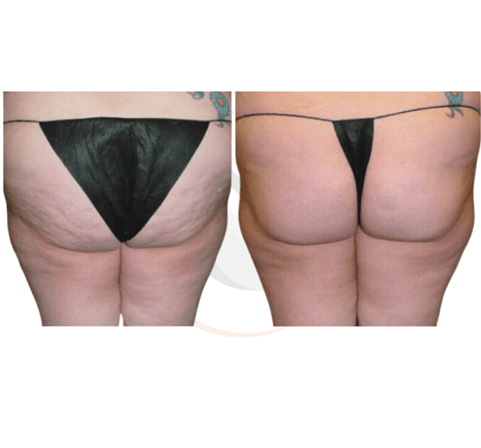tirzepatide cellulite Effective and Best Cellulite Treatments in Indianapolis, Indiana